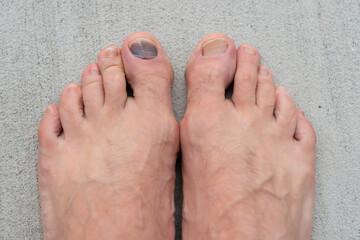 subungal toe nail bruise hemtoma. closeup of toe nail bruise hemtoma. toe nail bruise hemtoma