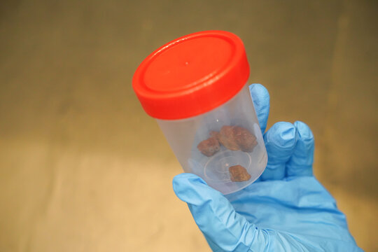 a sample of real stool for analysis in the laboratory. stool test
