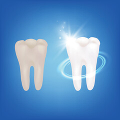 Realistic Detailed 3d Teeth Whitening Procedure Concept on a Blue. Vector illustration of Before and After Tooth Views