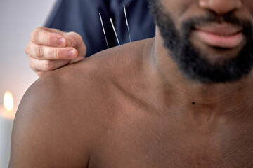 hand of professional doctor performing acupuncture therapy for black male client. young man undergoing acupuncture treatment with a line of fine needles inserted into the body skin in clinic hospital - obrazy, fototapety, plakaty