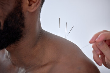 doctor performing acupuncture therapy for black male client. young man undergoing acupuncture treatment with a line of fine needles inserted into the body skin in clinic hospital, close-up - obrazy, fototapety, plakaty