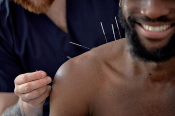 acupuncture therapy on back spine shoulders for black male client. cropped man undergoing acupuncture treatment with a line of fine needles inserted into body skin in clinic hospital, close-up - obrazy, fototapety, plakaty