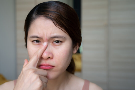 Portrait Of Unhappy Asian Woman Pointing To An Acne Occur Between Her Eyebrows. Allergies, Irritants, Genetic Makeup, Etc Can Cause Skin Conditions.