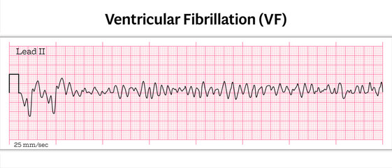 ECG Ventricular Fibrillation (VF) - 8 Second ECG Paper - Vector Medical Illustration