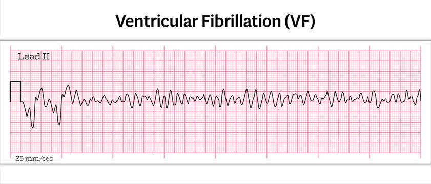 ECG Ventricular Fibrillation (VF) - 8 Second ECG Paper - Vector Medical Illustration