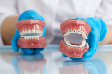 Orthodontist showing model of human jaw with wire braces and aligners explaining the difference