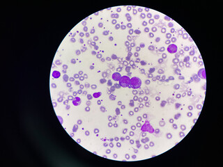 Leukemia blood picture show immature cells  mixed stage.