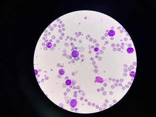 Leukemia blood picture show immature cells  mixed stage.