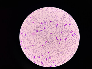 Leukemia blood picture show immature cells  mixed stage.