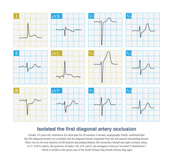 When the isolated first diagonal artery is occluded, ECG can show ST segment elevation in leads I, aVL, and V2, and ST segment depression in lead III, and the layout resembles the South African flag.