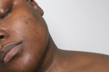 Brown skin with dark spots, hyperpigmentation on brown skin, african american woman with skin...