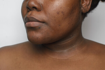 Brown skin with dark spots, hyperpigmentation on brown skin, african american woman with skin blemishes, imperfect skin