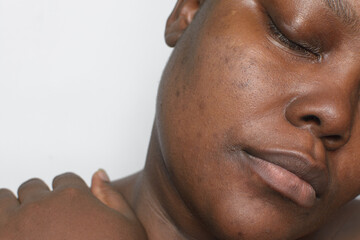 Brown skin with dark spots, hyperpigmentation on brown skin, african american woman with skin...