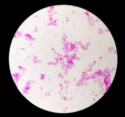 Photomicrograph of gram stain showing Bacterial Vaginosis