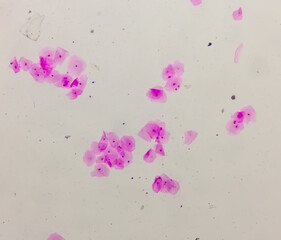 Photomicrograph of gram stain showing Bacterial Vaginosis