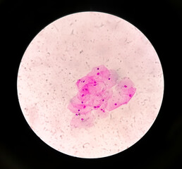 Photomicrograph of gram stain showing Bacterial Vaginosis