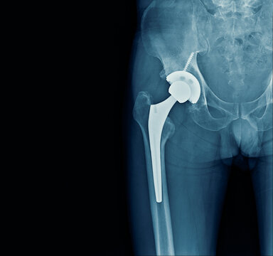 hip replacement on black background 
