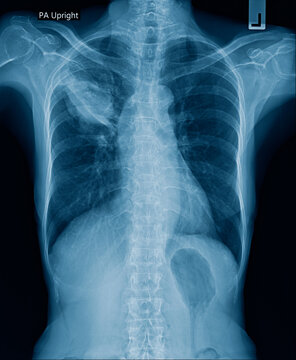 Chest x-ray image show right side lung atelectasis 