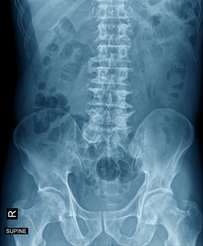 X-ray image of abdomen AP View to show thoraco-lumbar and pelvic bone in blue color 