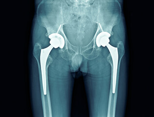 Bilateral hip replacement on black background 