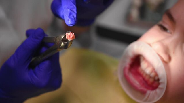 Focus on a freshly removed molar baby tooth in stainless steel forceps, in a dental surgeon's hands, against a blurred background of a child with a retractor in his mouth, sitting on a dentist's chair