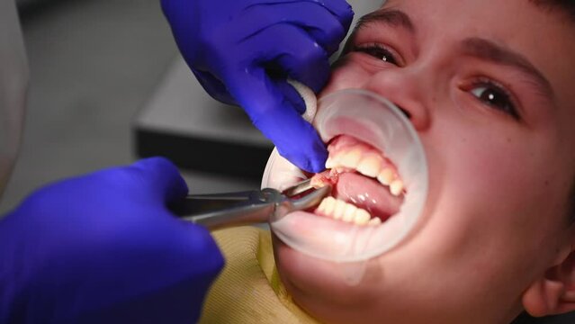 Extreme close-up of a doctor dentist surgeon, using stainless steel forceps, removes a molar baby tooth to a child patient with a retractor in his mouth, and puts a gauze swab on the bloody wound