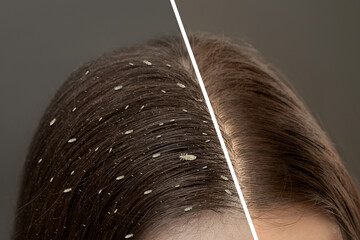 Collage showing woman's hair before and after lice treatment on grey background, closeup. Suffering...