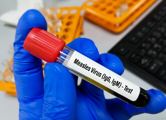 Measles virus antibody (IgG, IgM) test