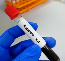 Blood sample for Histamine test, which can help doctors determine if a severe allergic reaction...