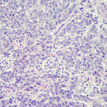 Camera photo of atypical mitotic figure in the background of breast carcinoma, magnification 400x, photograph through a microscope