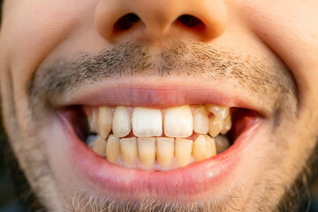 Close up of young man's face with crooked teeth. Teeth before install braces. need ortodontic doctor (dentist) help.