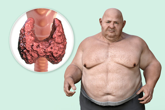 Autoimmune thyroiditis in obesity, conceptual  illustration showing a 3d render of overweight patient and 3d render of thyroid gland