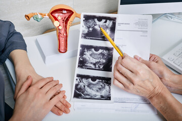 Gynecology, women's health. Gynecologist showing to woman ultrasound of her ovaries while visit to gynecology - 561499104