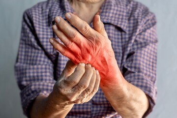 Asian woman scratching her hand. Concept of itchy skin diseases such as scabies, fungal infection, eczema, psoriasis, rash, allergy, etc.