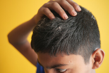 Fototapeta premium men with dandruff in his hair, closeup 