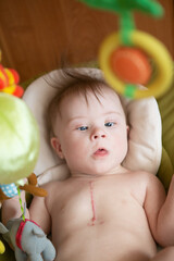 Portrait of a positive girl with Down syndrome. Heart surgery