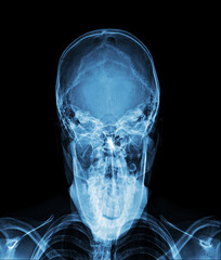 X-ray AP towns skull view