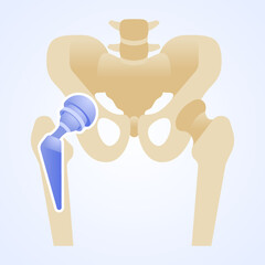 Titanium joint. Total hip replacement or arthroplasty. Structure of the artificial hip joint. Hip implant. Vector illustration