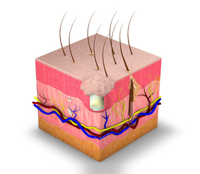 Section of skin with cyst, subcutaneous swelling. Pilar cyst and sebaceous cyst. Skin care, dermatology. 3d rendering

