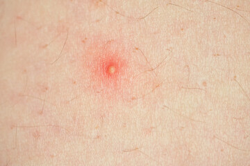 Acne, pus pimples, suppurating pimple, burst pimple with leaking pus closeup with shallow depth of field
