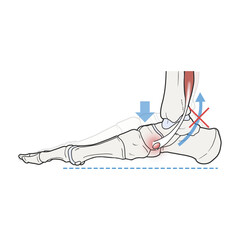 평발 후경골근 해부학 메디컬일러스트