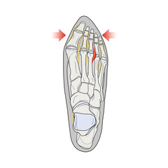 지간신경종 해부학 메디컬일러스트