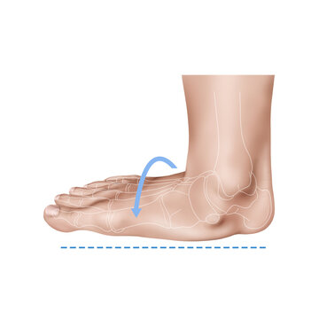 부주상골증후군 평발 해부학 메디컬일러스트