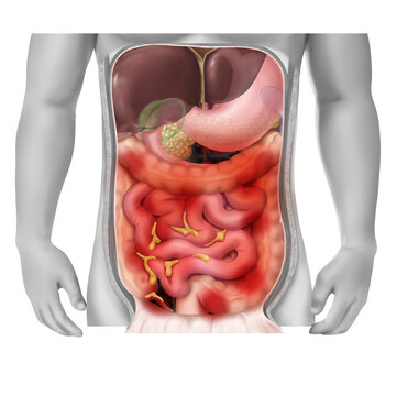 복막염 해부학 메디컬일러스트