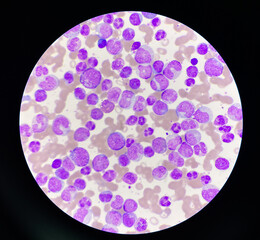 Blood smear leukaemia white blood cells blast.
