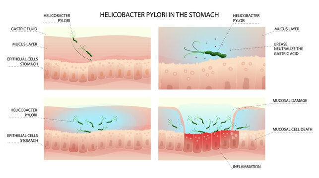 Helicobacter pylori infection process in human stomach with gastritis