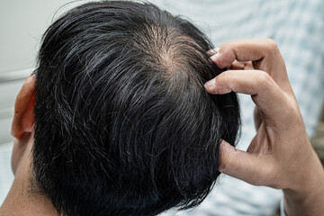 Bald in the middle head and begin no loss hair glabrous of mature Asian business smart active...