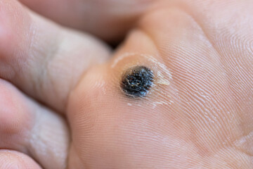 Fototapeta premium Closeup of dead skin around wart plantar after cauterizing it with celandine on infected foot. Hygiene, human skin disease, papillomavirus or HPV concept. Self-medication. 
