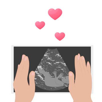 Ultrasound examination procedure. Pregnancy. An embryo in an ultrasound scan. The expectant mother holds a photo of the child in her hands. photo an embryo