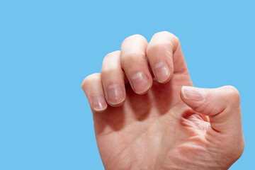 Close-up of a Caucasian female hand with natural unpolished nails, overgrown cuticles on blue background - obrazy, fototapety, plakaty